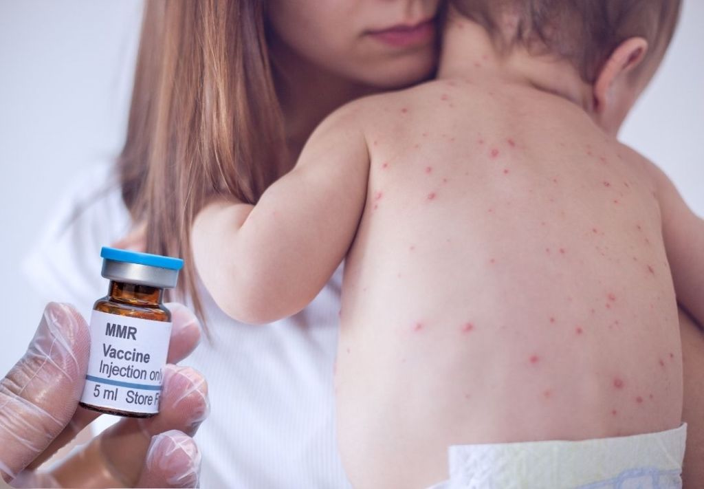 A healthcare worker administering an MMR vaccine injection to a child's back, which is covered in a rash.